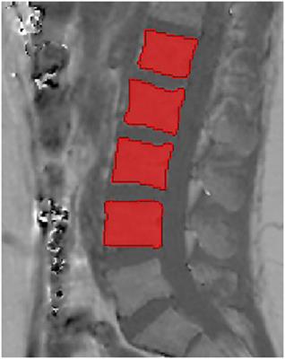 Anatomical Variation of Age-Related Changes in Vertebral Bone Marrow Composition Using Chemical Shift Encoding-Based Water–Fat Magnetic Resonance Imaging